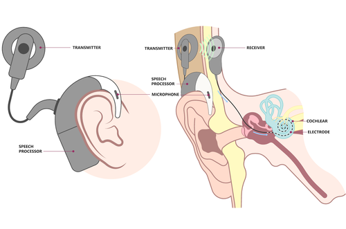 Cochlea Implantat